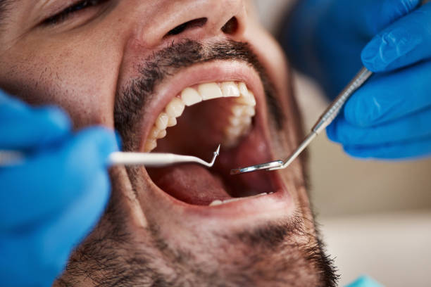 Best Emergency Dentist for Knocked-Out Tooth in Simonton Lake, IN